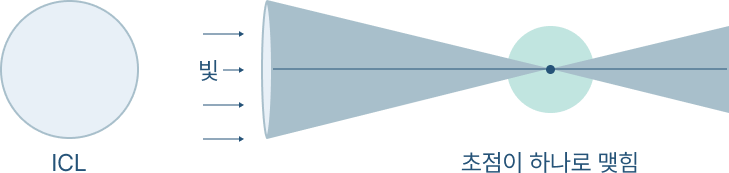 단초점 안내 콘택트 렌즈(ICL)의 초점을 맞추는 방법